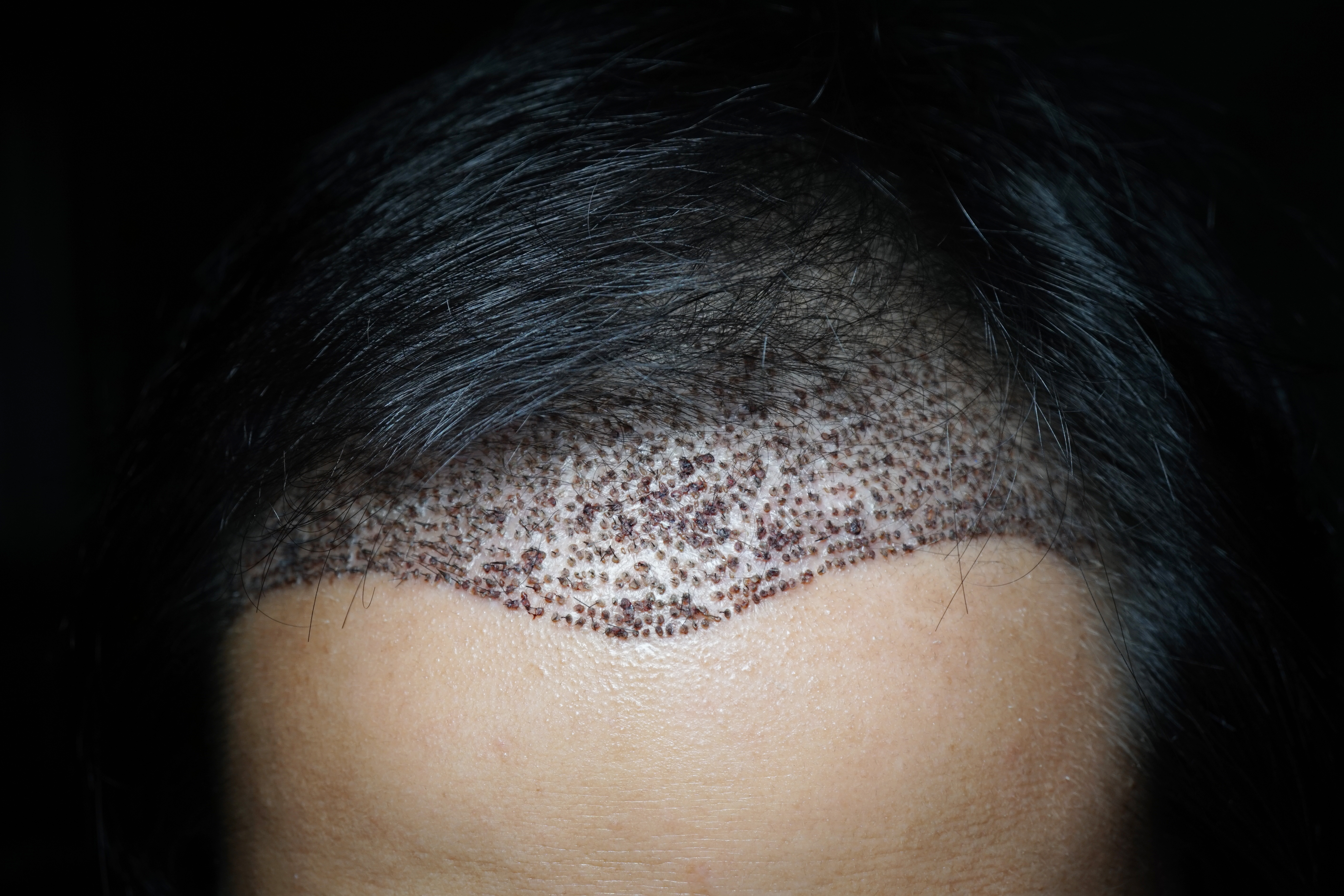 Die FUE-Methode zur Haartransplantation - Alles, was Sie wissen müssen