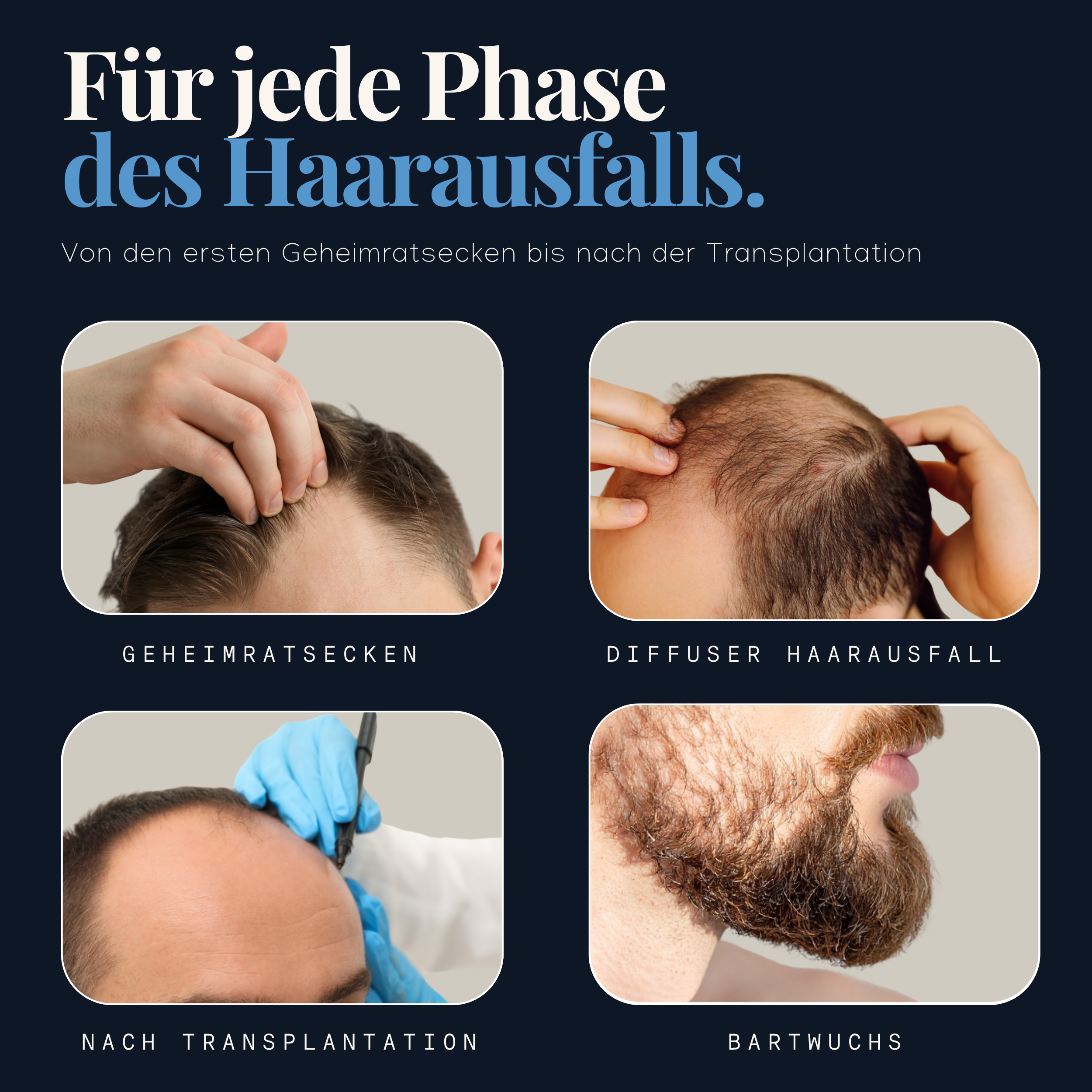Hairforte Spray für Männer 3% Procapil gegen Haarverlust DHT Blocker 3er Set